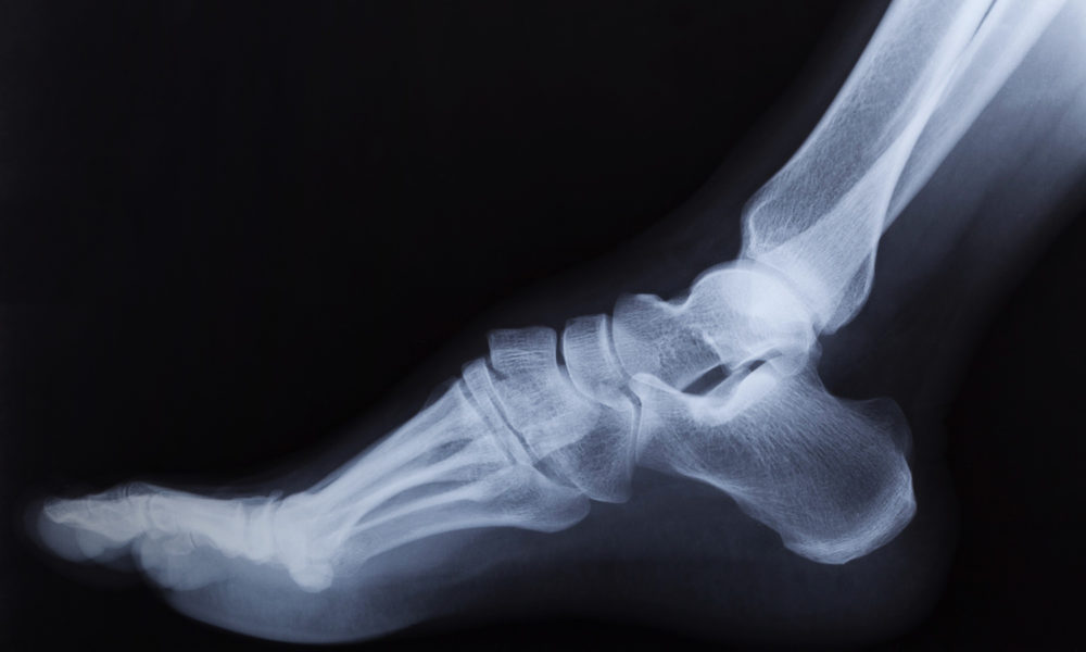 Osteoartrite em atletas: uma lesão silenciosa