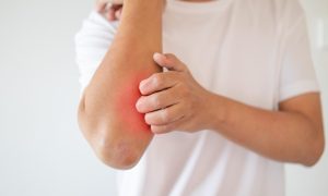 Urticaria ao exercício